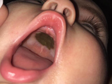 me-phat-hoang-thay-mieng-con-xuat-hien-dom-den-la-den-benh-vien-nghe-bac-si-chuc-mung-ma-xau-ho