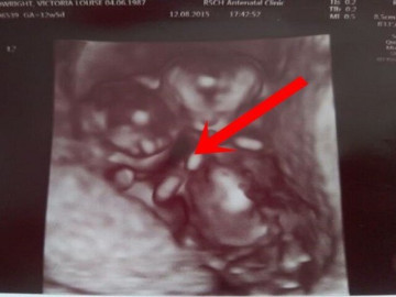 me-bau-mang-thai-doi-cuc-dac-biet-bac-si-noi-dua-tre-kho-song-sot-nhung-sieu-am-thay-canh-tuong-ky-dieu