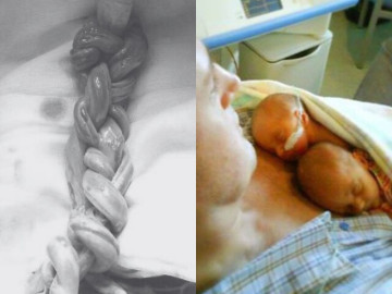 cap-sinh-doi-mac-benh-hiem-hai-day-ron-dan-nhau-nhu-tet-toc-van-song-sot-ky-dieu-chao-doi-cuc-xinh