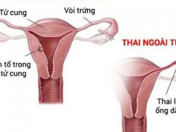 cau-hoi-thuong-gap-ve-mang-thai-ngoai-tu-cung